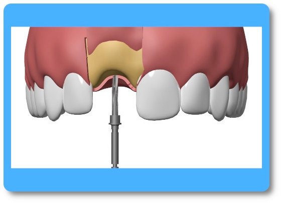 implant dentaire Pont à Mousson
